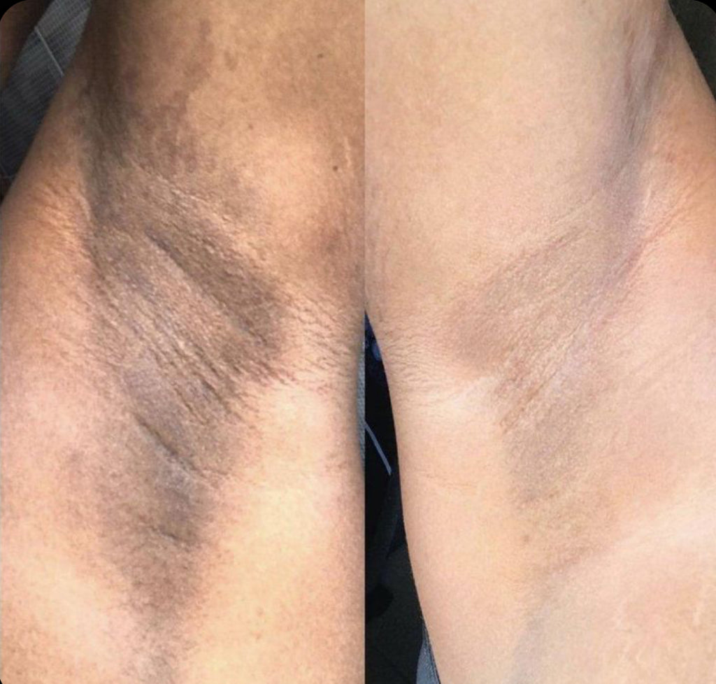 avant apres zones sombres gant exfoliant AURAYU