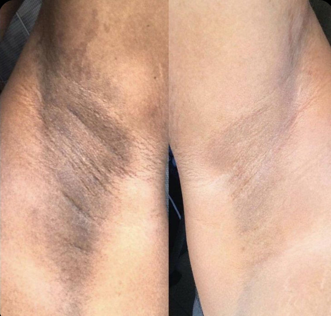 avant apres zones sombres gant exfoliant AURAYU